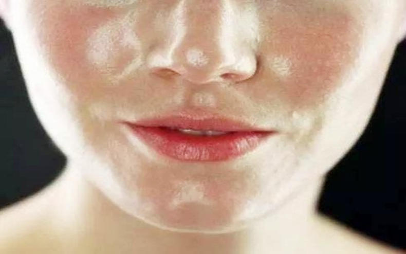 脸上有螨虫脱皮痒涂什么,脸上频繁瘙痒起米粒