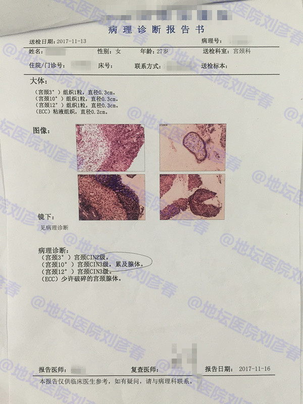 病例分享——27岁女性宫颈CIN3级病变并累及腺体，意味着什么？