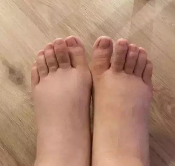 妹子脚肿成猪蹄,产妇脚肿是怎么回事