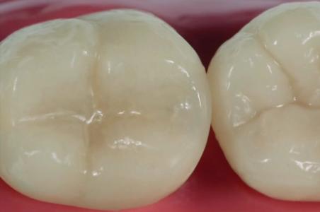 树脂补牙什么意思,树脂补牙是什么原因引起的