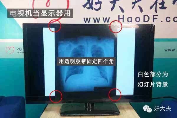 家里怎么拍片子给医生,如何把拍的ct片发给医生