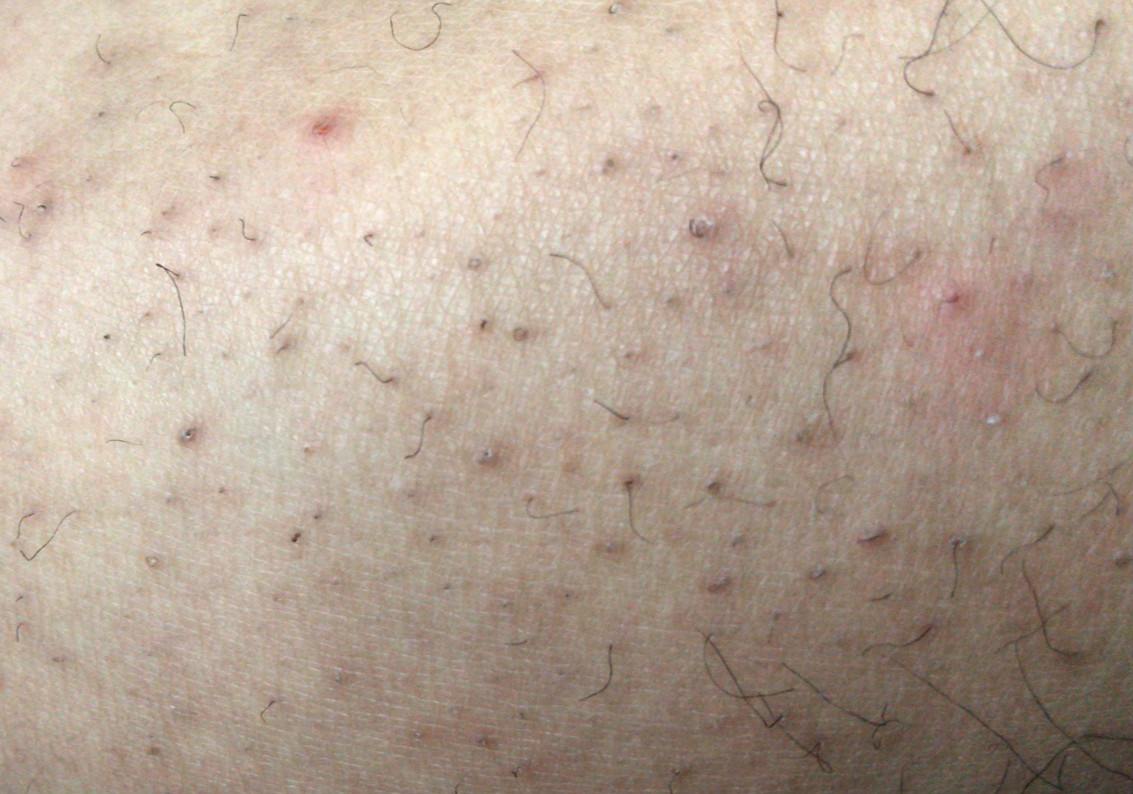 汗毛缩在毛囊里是怎么回事,汗毛蜷缩在毛孔里就是戳不出来