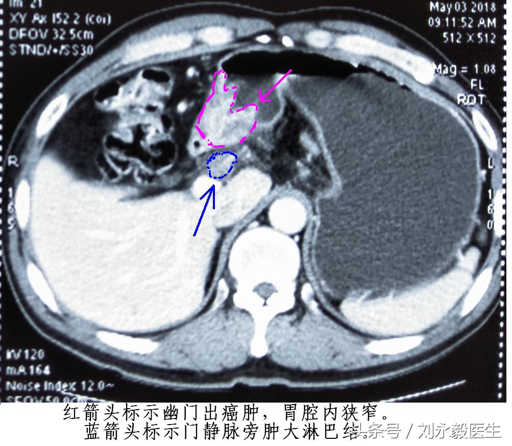 老人脖子左边出了肿块是怎么回事,32岁脖子左侧里有个疙瘩