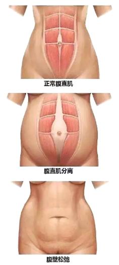 产后腹直肌分离会导致肚子大么,小肚子突出腹直肌分离图片