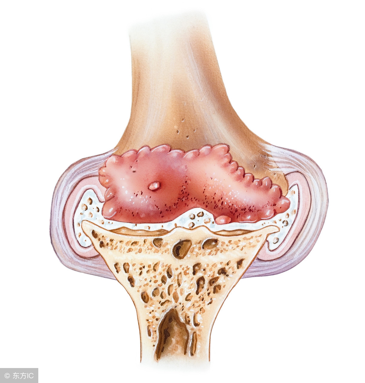 骨质疏松相关综述,骨质疏松与骨质增生的区别