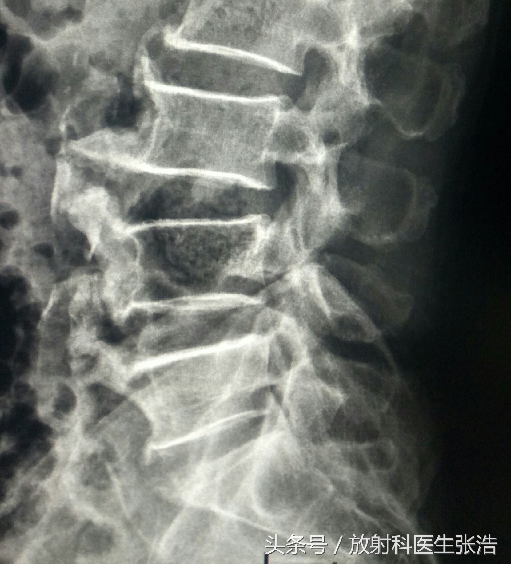 腰椎骨质增生的影像表现,颈椎骨质增生影像视频