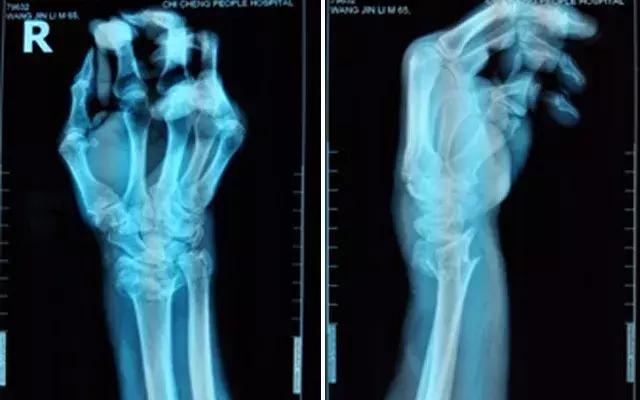 医生说骨头愈合很好,医生说恢复很好骨头没长