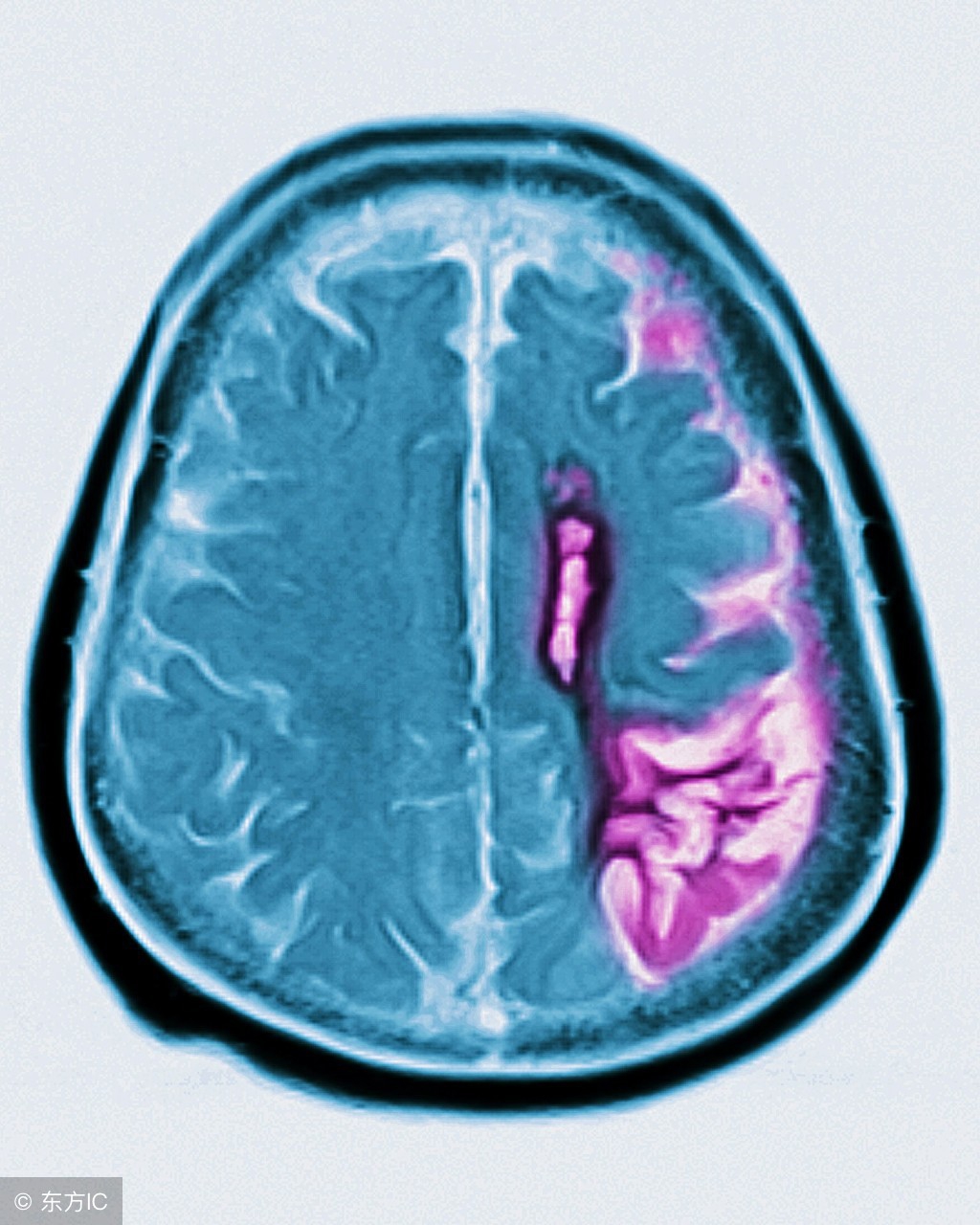 脑萎缩关注事项及防护,脑萎缩关注哪些事项