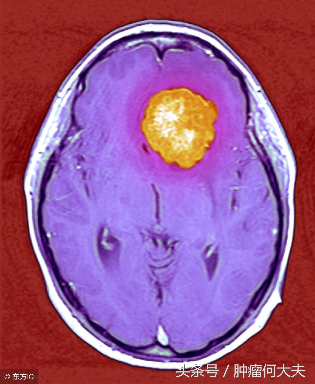 脑膜瘤是良性？恶性？症状如何？如何治疗？