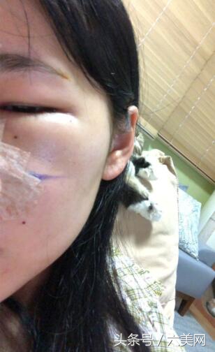 隆鼻后如何克服焦虑,隆鼻后前三天态势