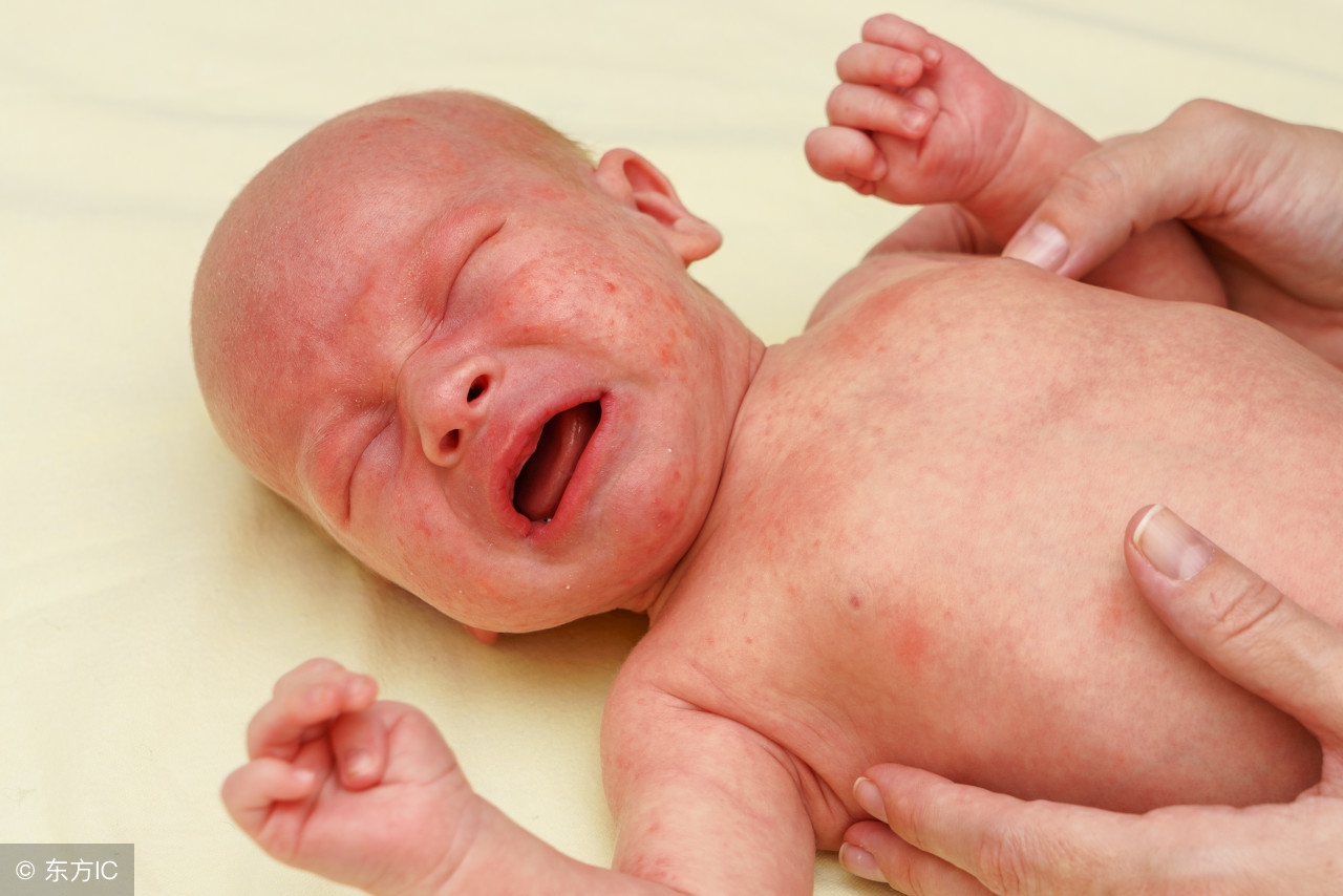 婴儿长了湿疹用什么药膏,婴儿长湿疹怎么快速消除