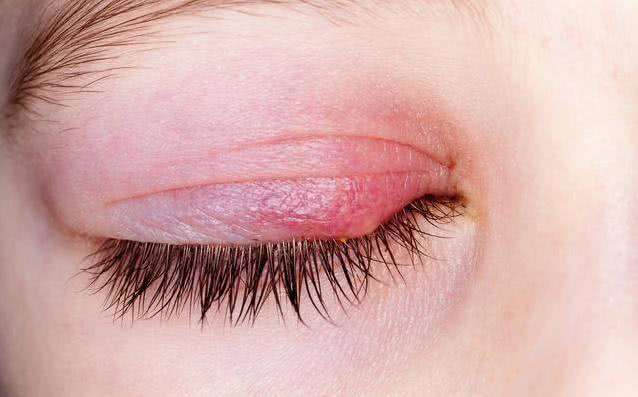 眼睛里面长了一个小白点又疼又痒,眼睛上方长了个疙瘩有一点红肿痒