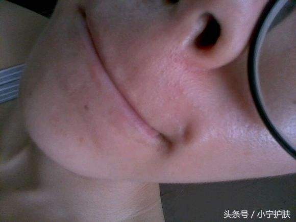 皮肤泛红起疹子用什么护肤,皮肤发红暗怎么办啊