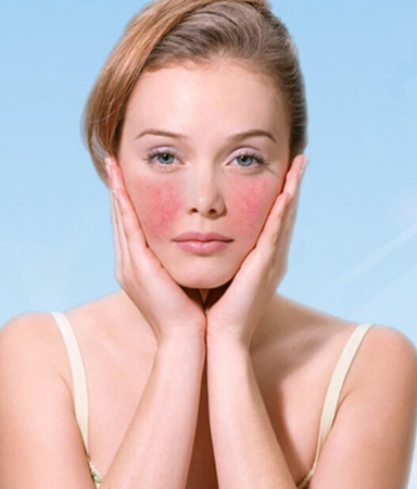 脸上角质层薄经常脸红怎么治,角质层薄弱脸红用什么甘油比较好