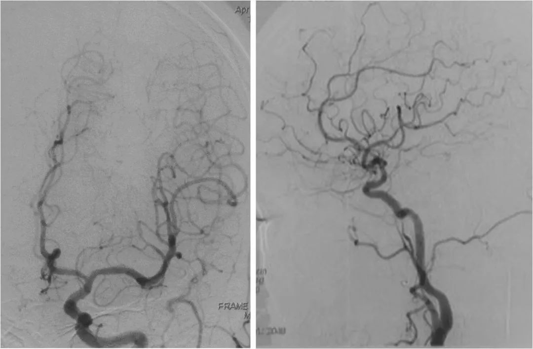天坛周记｜右大脑中动脉重度狭窄血管内介入治疗1例