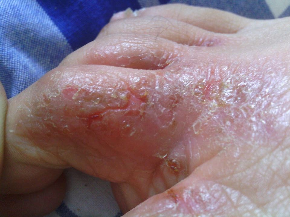 脚气引起皮质增厚怎么用药,脚气用碘伏之后可以用药吗