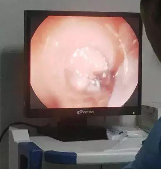 食管反流挂什么科做什么检查,胃镜可以检查出胃食管反流吗