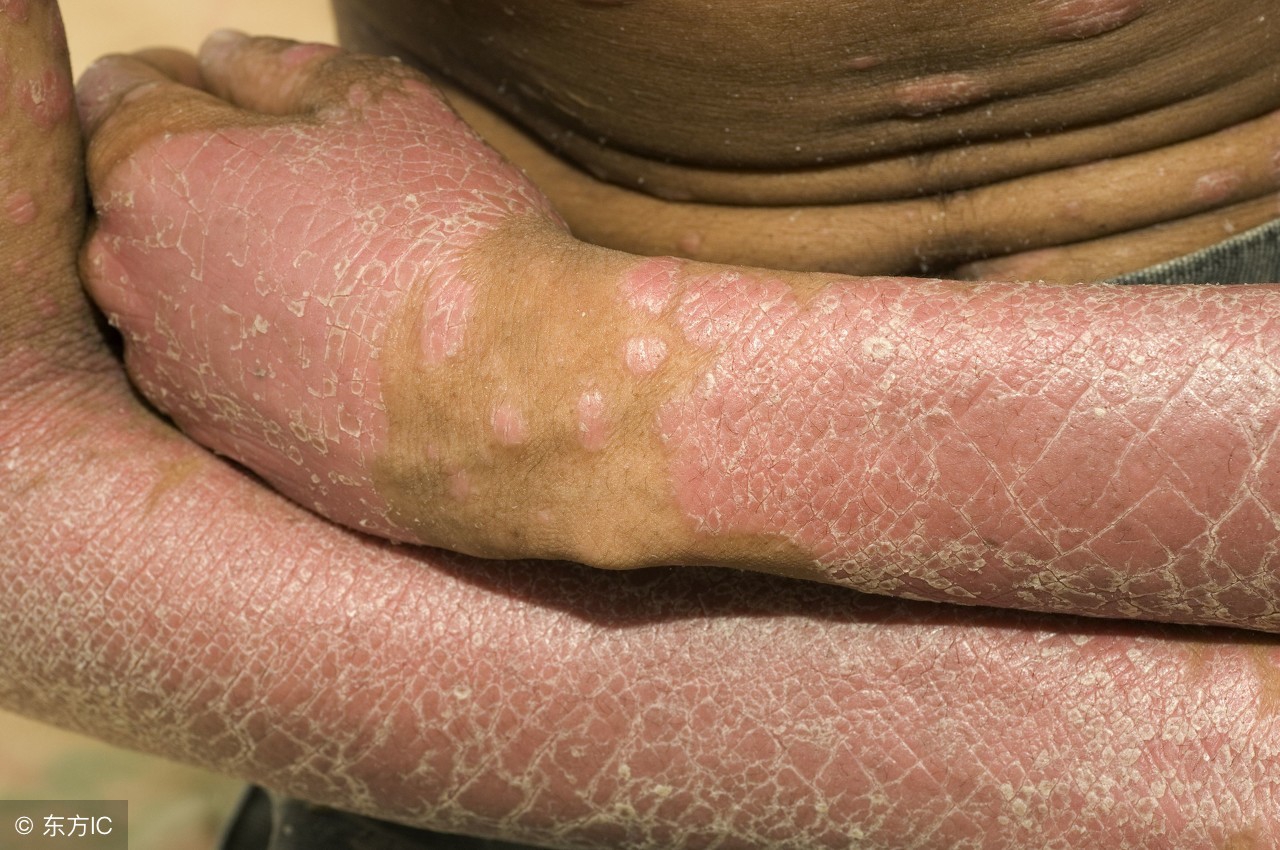 孩子先天性鱼鳞病长大后怎么样,先天性鱼鳞病身体发痒怎么治疗