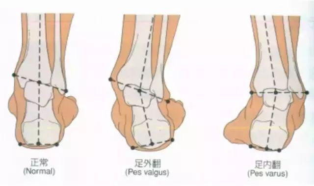 经常性崴脚恢复练习,崴脚后怎么恢复训练