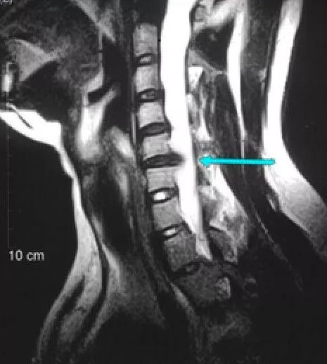 每天这样做，颈椎病竟然全好了！90%的人都不知道...