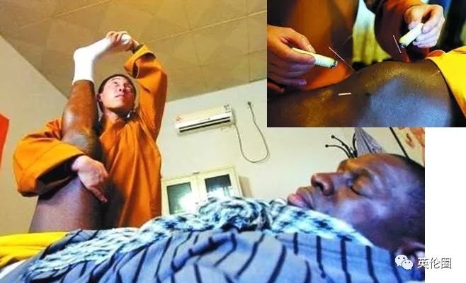 哈里梅根婚前求助中医！歪果仁已经把针灸吹上了天