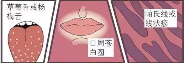 手足口病的病毒类型有地区差异吗,没有疫苗的手足口病有哪些症状