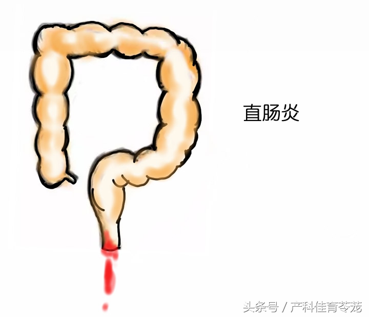 宝宝眼睛脓性分泌物是哪种,儿童沙眼衣原体感染的症状表现