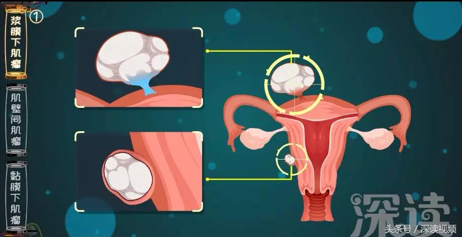 子宫肌瘤在哪个地方影响怀孕,子宫肌瘤剔除怎么还有东西流出来