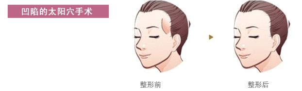 太阳穴填充需要关注什么才能更美,太阳穴填充怎么才能填得高级