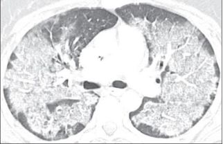 蝶翼征是间质性肺水肿的表现吗,肺蝶翼征
