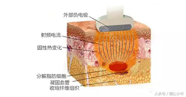 顽固性易胖体质怎么瘦下去,145斤易胖体质能瘦下来吗