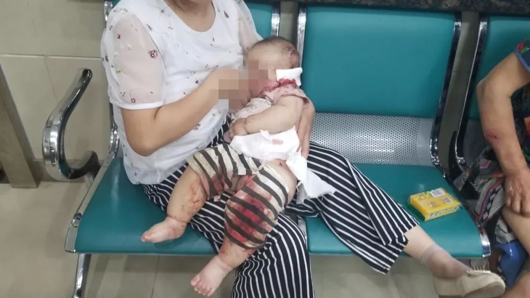 可怕！半岁宝宝被大狗叼走，头骨被咬穿，需做开颅手术！避免被狗咬应该这么做……