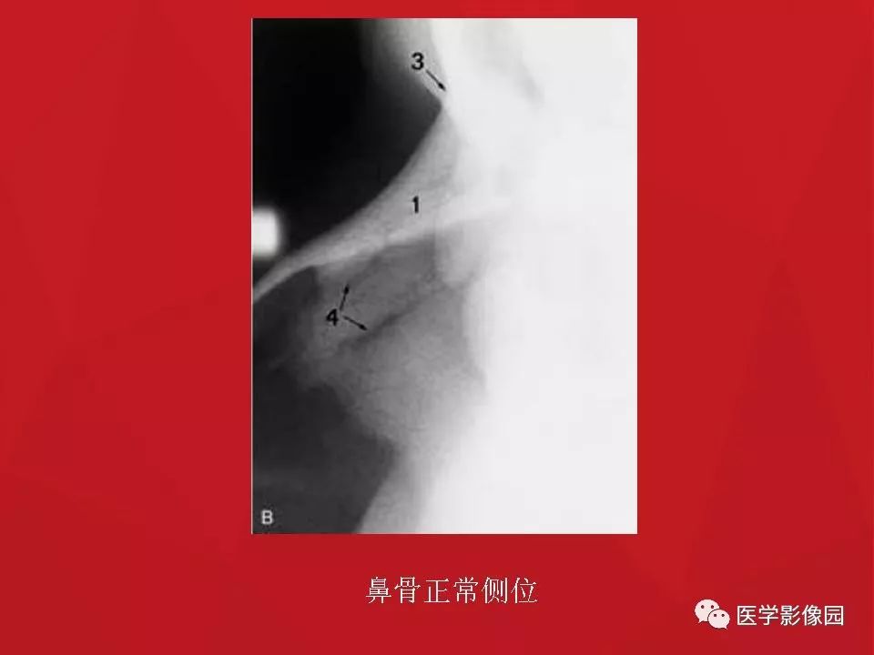 左侧鼻骨骨折伴鼻中隔骨折,双侧鼻骨及左上颌骨突骨折