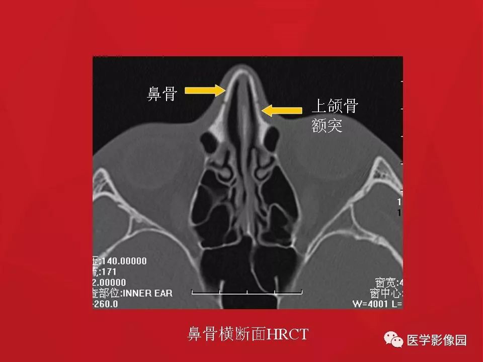 左侧鼻骨骨折伴鼻中隔骨折,双侧鼻骨及左上颌骨突骨折