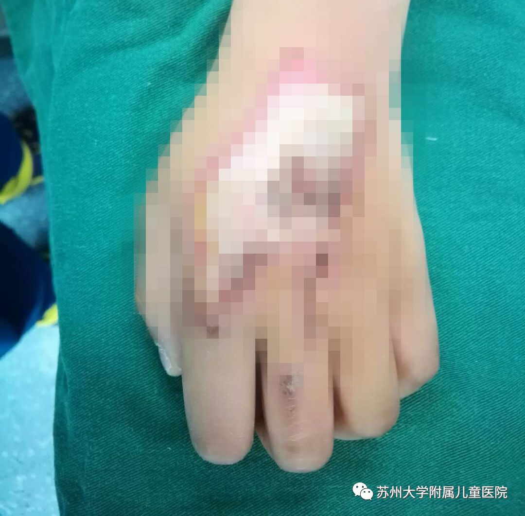 三岁小女孩的手被铁钉划伤原视频,三岁小女孩手被铁钉刮伤
