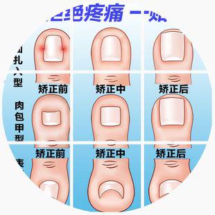 脚趾甲嵌到肉里很疼怎么办,脚趾甲好痛碰到肉就痛怎么回事