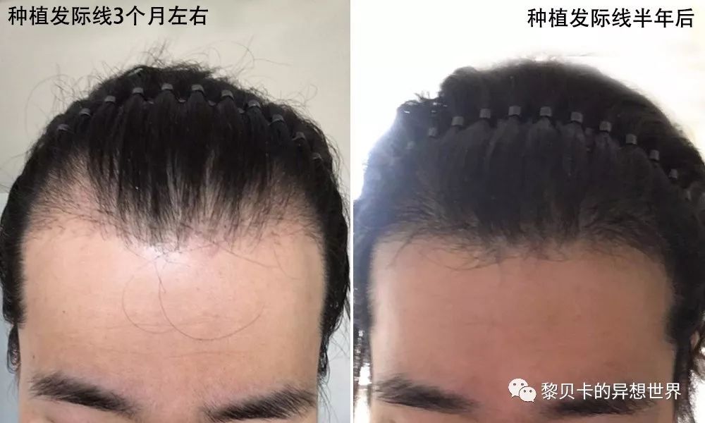 揭秘种植发际线,发际线种植真实体验