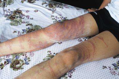 被海蜇蜇了需要涂什么药,被海蜇蜇伤