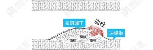 血管硬化可以逆转吗,血管粥样硬化能逆转吗