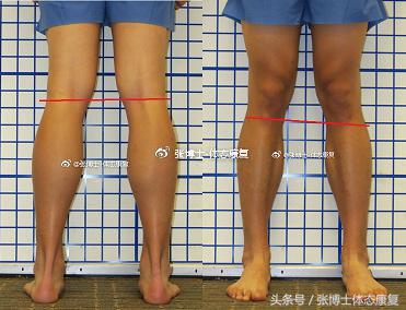 矫正长短腿去哪里矫正,体态矫正腿