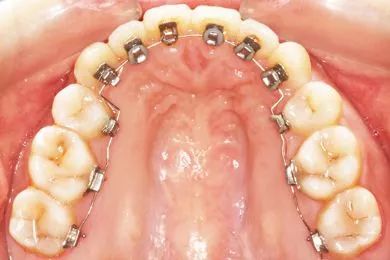 暑期孩子想矫正牙齿？北京口腔医院专家来解答这10个问题