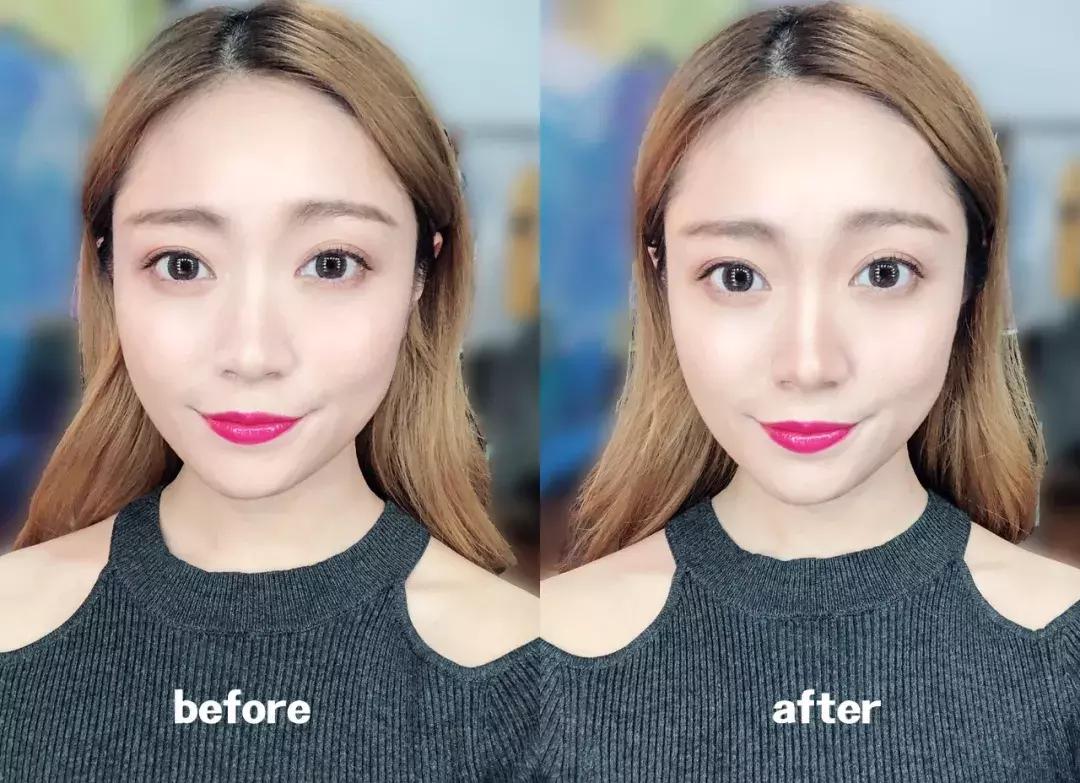 蒜头鼻怎么改变鼻型,蒜头鼻厚鼻翼怎么矫正