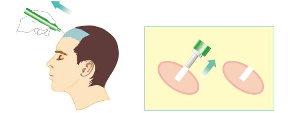 头发是怎么种出来的,种头发能和原来头发一样吗