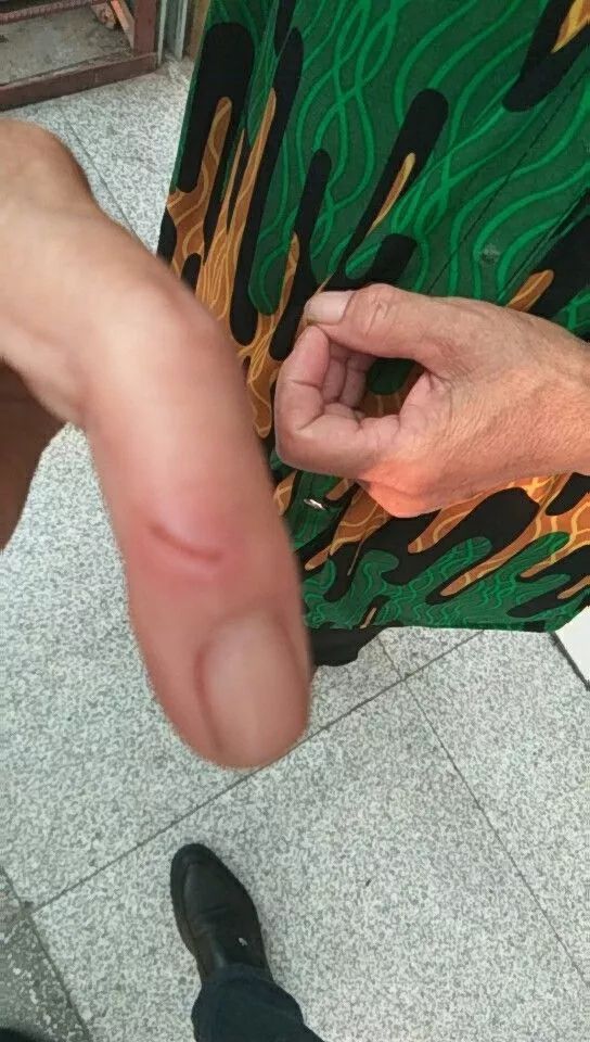 郑州一女子被鼠咬后续,郑州女子被仓鼠咬伤