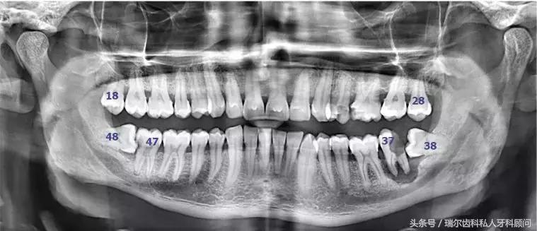 又肿又痛不会白怎么处理,又肿又痛可以去拔牙吗