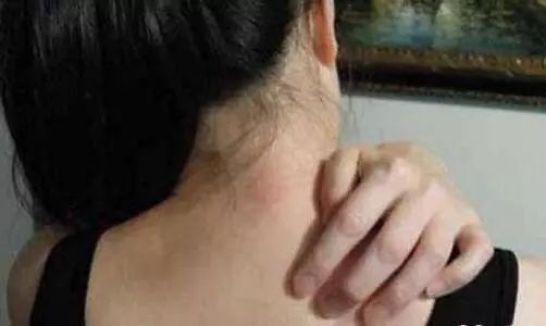 高温天气过敏了怎么办,皮肤暴晒太阳过敏症状