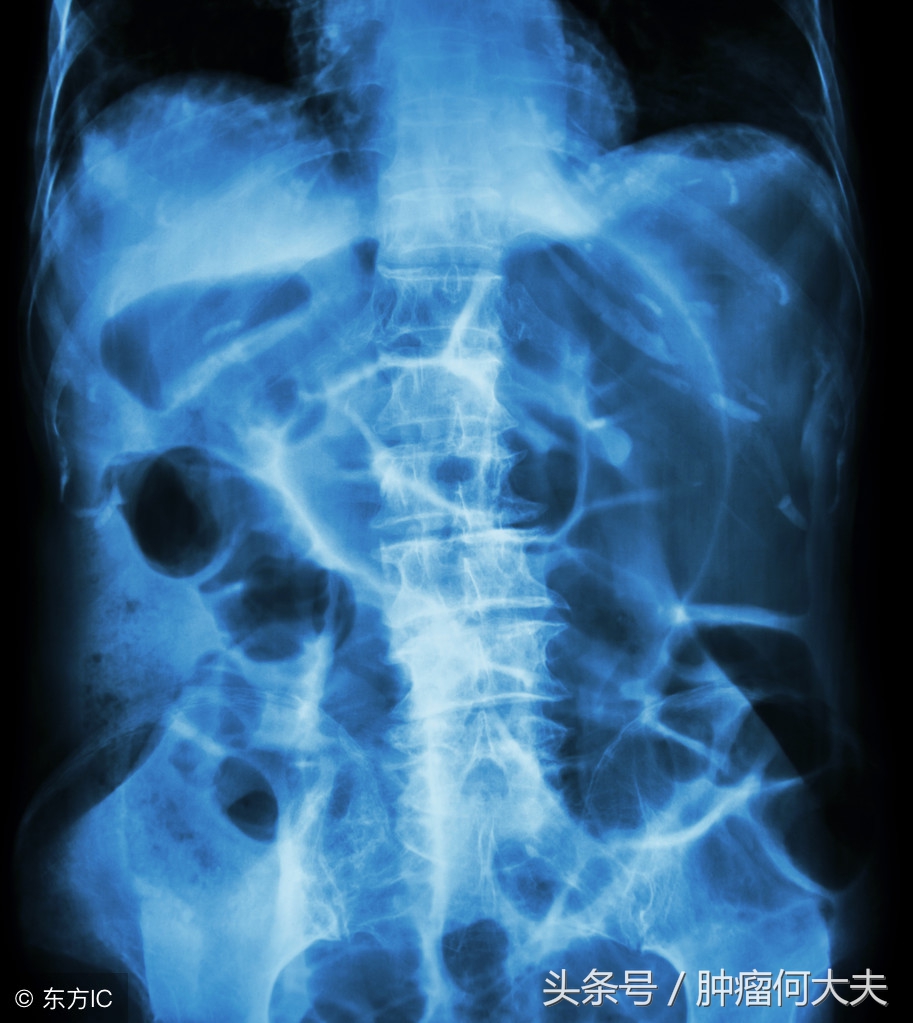 肠癌术后一年每天饮食食谱,肠癌十大禁忌食物