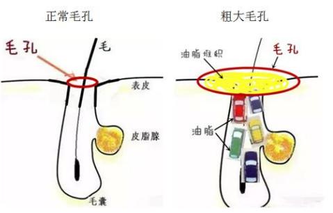 解决毛孔粗大简单有效的方法,毛孔粗大如何拯救学生党