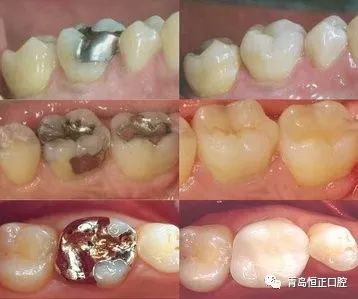 为什么补牙过后还会牙疼,补牙后反而牙疼是什么原因