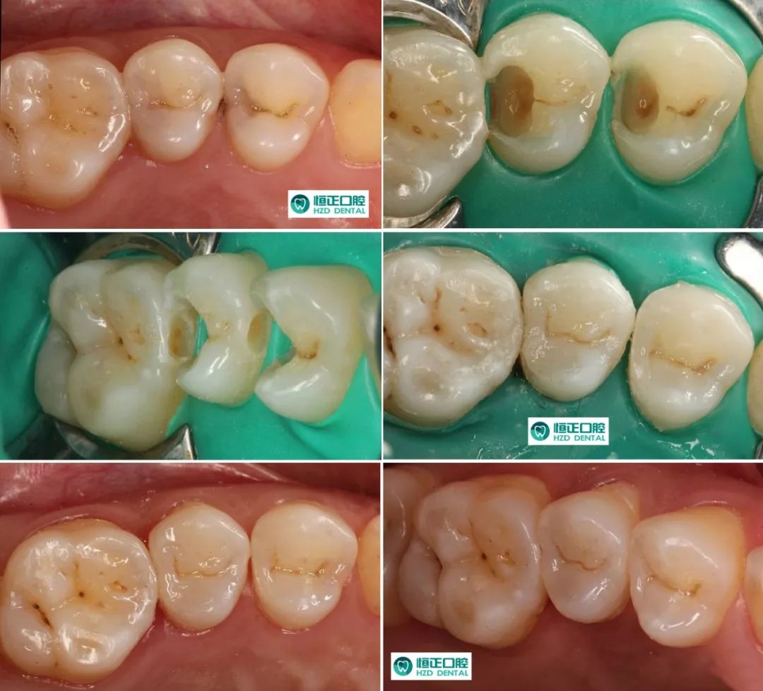 为什么补牙过后还会牙疼,补牙后反而牙疼是什么原因